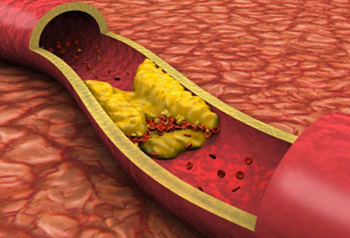 چربي خون بالا